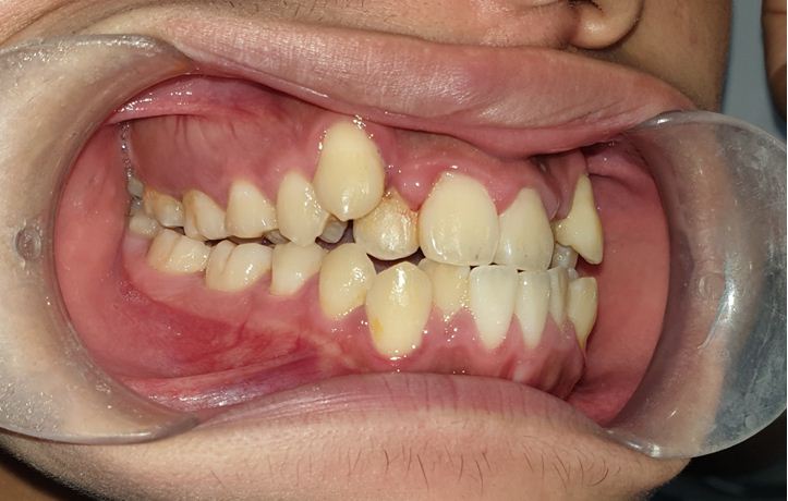 Tình trạng viêm lợi do chen chúc, khấp khểnh răng gây ra